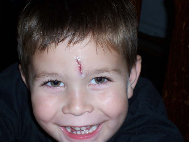 Max's Harry Potter Scar